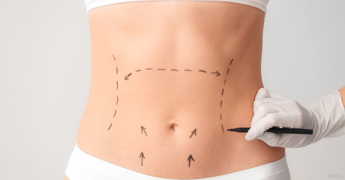 The doctor is drawing plastic surgery marks with a pen on the woman's abdomen for a tummy tuck (Model)