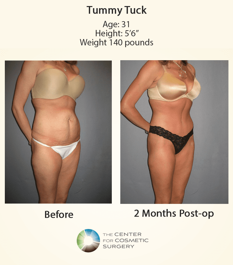 https://www.thecenterforcosmeticsurgery.net/content/uploads/2018/11/SDV-BlogGraphicNovember18-BeforeAfter2-vertical-images.png