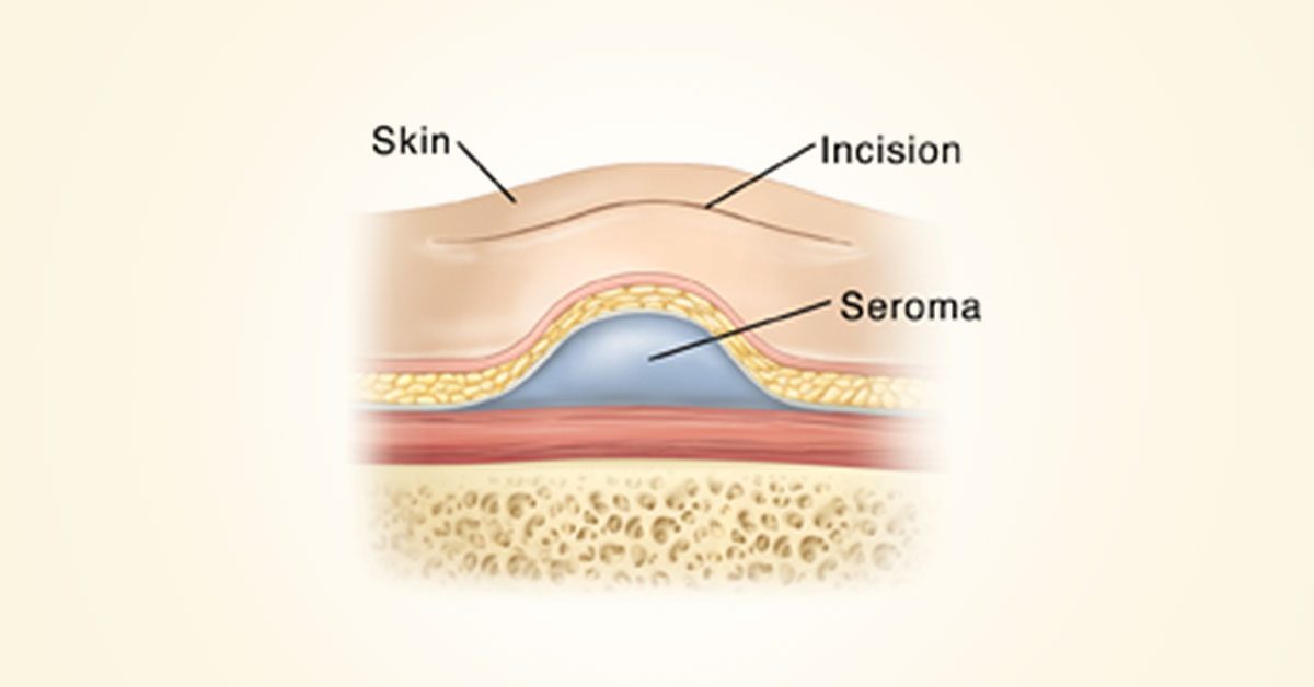 Illustration of a seroma after surgery