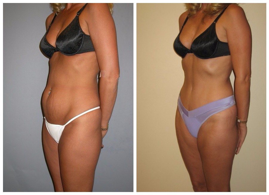 Modelling Mons pubis correction: Reward yourself with a bikini body