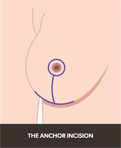 Illustration of an anchor incision on the breast.