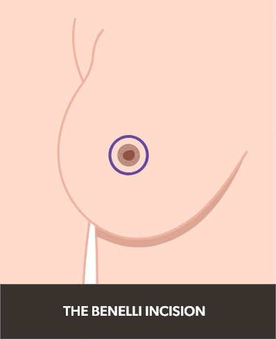 Illustration of a benelli incision on the breast.