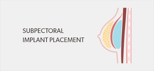 Illustration of breast implant placement.