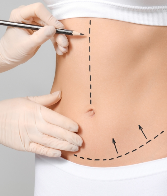 Lines being drawn on a patients stomach for a tummy tuck.