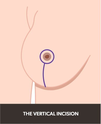 Illustration of a vertical incision on the breast.